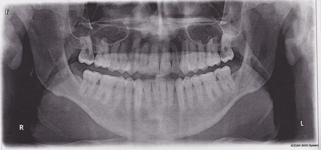 Surfrock66's Teeth
